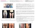 84777 : liposuccion et alternatives de la liposuccion en chirurgie esthétique et médecine esthétique